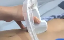 Viêm tụy cấp tái phát vì sử dụng rượu, bia