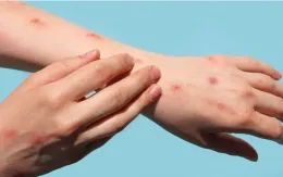 Bộ Y tế yêu cầu tăng cường giám sát, phát hiện ca nghi ngờ đậu mùa khỉ ngay tại cửa khẩu