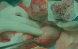 Lấy khối u quái nặng gần 1kg trong dạ dày bé sơ sinh