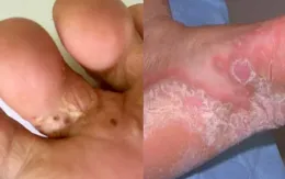 Phòng tránh bệnh về da và nguy cơ bỏng mùa bão lũ