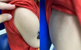 Bé trai suy tuyến thượng thận do cha mẹ tự ý sử dụng thuốc gia truyền hỗ trợ tăng cân