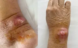 Nhiều người phải nhập viện do mèo cào, cắn