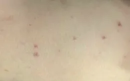 Trẻ mắc não mô cầu nặng do chưa tiêm vaccine phòng bệnh