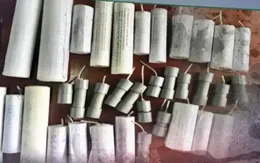 Một bệnh nhân bị bỏng nặng vùng mặt do chơi pháo