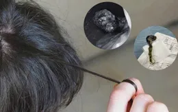 Cảnh báo tình trạng nhổ tóc, ăn tóc ở trẻ nhỏ