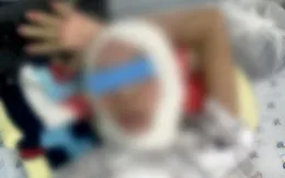 Trẻ bỏng nặng do đốt cồn với lúa làm cốm nổ