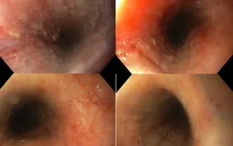 Bé gái 20 tháng tuổi bỏng niêm mạc thực quản và dạ dày do uống nhầm hóa chất