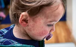 Mỹ: Bùng phát dịch sởi tồi tệ nhất trong gần 30 năm ở Texas