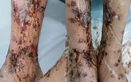 Cảnh giác tình trạng viêm da nhiễm trùng do chăm sóc sai cách