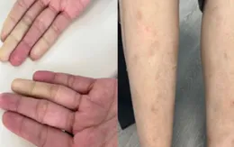 Người phụ nữ mắc bệnh tự miễn hiếm gặp