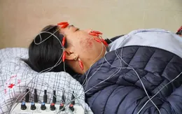 Liệt mặt biến chứng do tự ý điều trị bệnh tại nhà