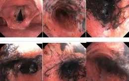 Cứu sống người bệnh ngạt khí gây bỏng khí quản, xẹp phổi do muội than