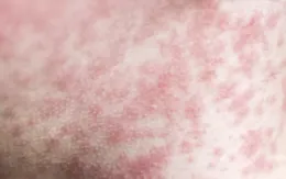 Bé gái sốt cao, phát ban đỏ khắp người vì mắc bệnh truyền nhiễm nguy hiểm