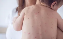 Đề phòng bệnh da liễu khi thời tiết nồm ẩm kéo dài