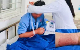 Cánh tay bị loét, tấy đỏ vì đắp thuốc lá giảm đau