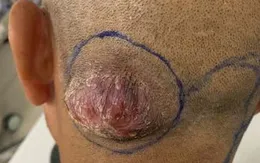 Phát hiện mắc ung thư da ở vị trí đặc biệt