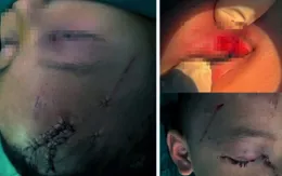 Nghệ An: Cấp cứu trẻ bị chó cắn tổn thương nghiêm trọng vùng mặt