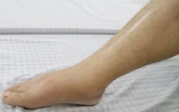 Cầu cứu bác sĩ sau 5 tháng đắp thuốc nam trị gãy xương tại nhà