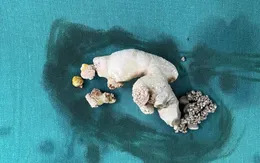 Loại bỏ sỏi thận san hô cho người phụ nữ