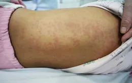 Cảnh báo bệnh sởi ở trẻ nhỏ và người lớn