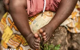 Số ca tử vong do đậu mùa khỉ ở châu Phi đáng lo ngại