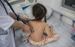 Dịch sởi nghiêm trọng nhất trong nhiều năm tại Mỹ