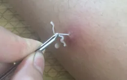Bệnh giun rồng nguy hiểm còn lưu hành tại Việt Nam