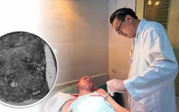 Nghệ An: Bệnh nhân 14 tuổi bị nhiễm trùng hoại tử do chữa bỏng bằng thuốc nam