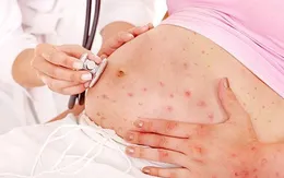 Mẹ bầu mắc sởi - Có ảnh hưởng em bé?
