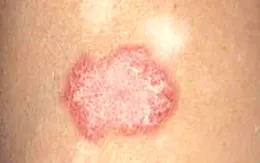 Điều trị thành công cho 2 bệnh nhân bị lupus ban đỏ hệ thống