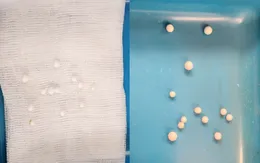 Cảnh báo: Phát hiện 12 dị vật trong hốc mũi của trẻ 3 tuổi