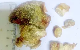 Lấy khối sỏi san hô lớn ở thận người bệnh