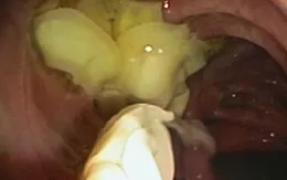 Sán dây dài gần 1m ký sinh trong ruột vì thói quen ăn đồ tái, sống