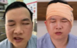 Liệt dây thần kinh số VII ngoại biên sau bị ngã