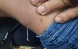 Sự trở lại của bệnh giun rồng: Việt Nam ghi nhận 25 ca mắc trong 5 năm