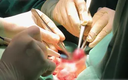 Loại bỏ bướu giáp lớn gây chèn ép khí quản cho người đàn ông