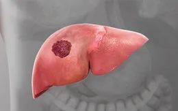 Phát hiện hợp chất tự nhiên có khả năng ức chế sự phát triển của ung thư gan