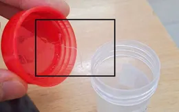 Gắp ký sinh trùng dài gần... 10cm trong mắt người phụ nữ