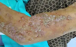 Cảnh báo biến chứng nặng vì bôi dầu gió khi bị Zona