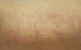 Cứu sống bé trai 8 tháng tuổi bị sởi biến chứng suy hô hấp nặng