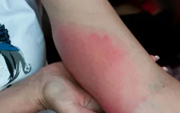 Cẩn trọng với nguy cơ phản vệ do ong đốt trong mùa hè