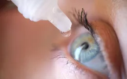 Cảnh báo đục thủy tinh thể thứ phát do tự ý dùng thuốc nhỏ mắt chứa corticoid