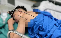 Nam thanh niên 17 tuổi bị dị vật kim loại tự chế xuyên thấu tim