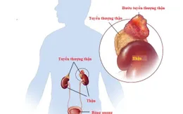 Tăng huyết áp bất thường hé lộ khối u thượng thận: Ca bệnh điển hình được xử trí kịp thời