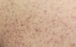 Cảnh báo dấu hiệu trở nặng ở trẻ mắc sốt xuất huyết
