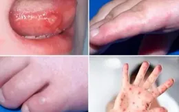 TP Hồ Chí Minh: Ca mắc tay chân miệng tăng trở lại trong tuần 18