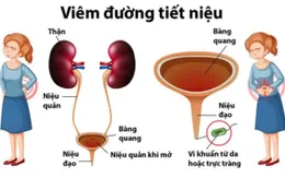 Nhiễm trùng tiết niệu ở phụ nữ tiền mãn kinh: Nguy cơ âm thầm, biến chứng nguy hiểm