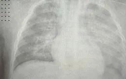 Bé 8 tháng tuổi phổi trắng xóa do biến chứng sởi
