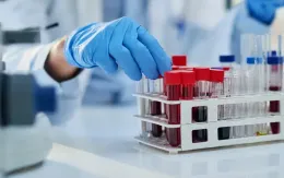 Thử nghiệm công nghệ xét nghiệm máu sử dụng AI chẩn đoán sớm ung thư ruột