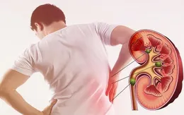 Sỏi tiết niệu: Cách phòng ngừa và điều trị kịp thời để tránh biến chứng nguy hiểm